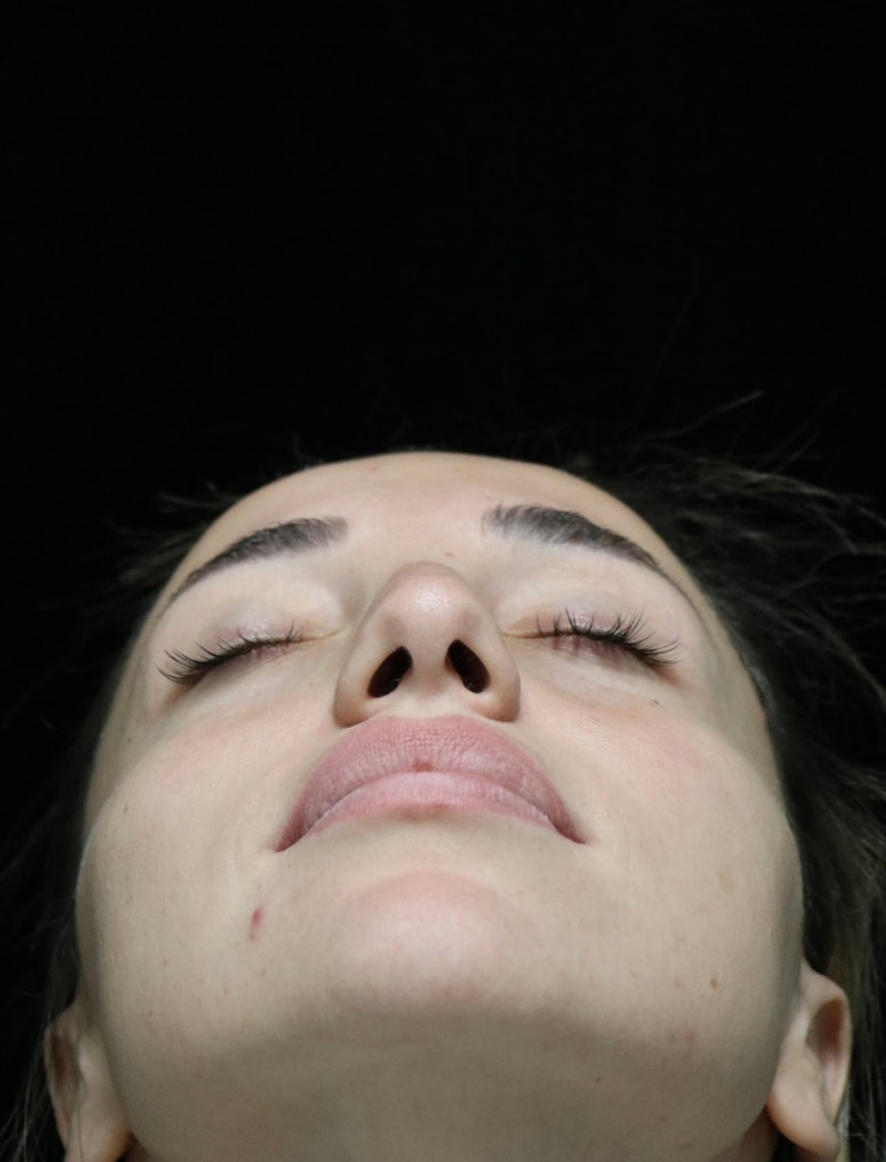 Beverly Hills Rhinoplasty Before & After Gallery - Patient 254674 - Image 13 Dr. Deepak Raj Dugar