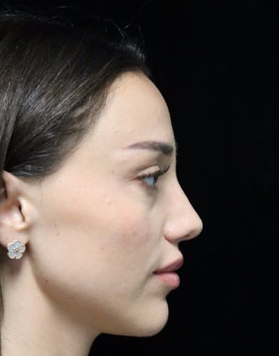 Beverly Hills Rhinoplasty Before & After Gallery - Patient 254674 - Image 2 Dr. Deepak Raj Dugar