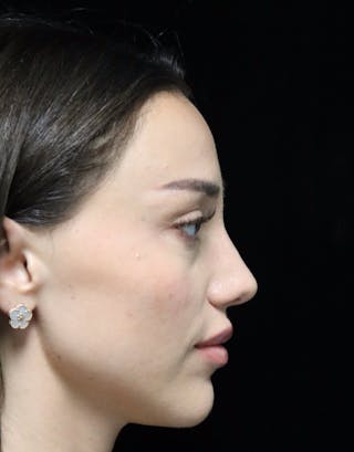 Beverly Hills Rhinoplasty Before & After Gallery - Patient 254674 - Image 2 Dr. Deepak Raj Dugar