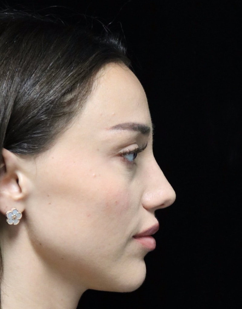 Beverly Hills Rhinoplasty Before & After Gallery - Patient 254674 - Image 2 Dr. Deepak Raj Dugar