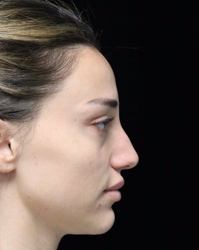 Rhinoplasty Before & After Gallery - Patient 254674 - Image 1