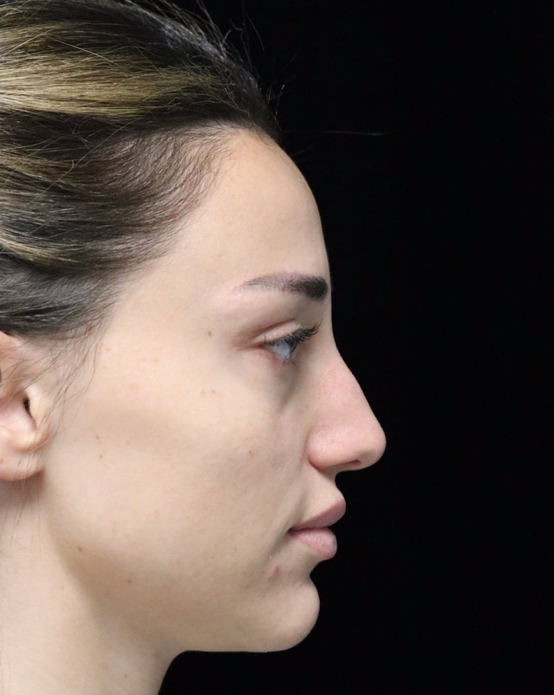 Beverly Hills Rhinoplasty Before & After Gallery - Patient 254674 - Image 1 Dr. Deepak Raj Dugar