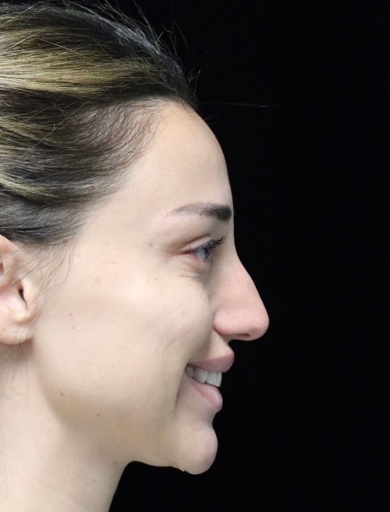 Beverly Hills Rhinoplasty Before & After Gallery - Patient 254674 - Image 3 Dr. Deepak Raj Dugar