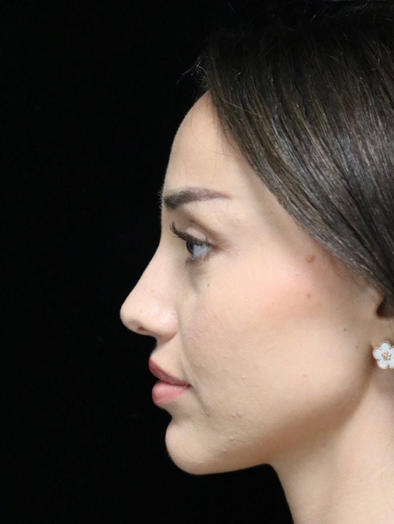 Beverly Hills Rhinoplasty Before & After Gallery - Patient 254674 - Image 6 Dr. Deepak Raj Dugar