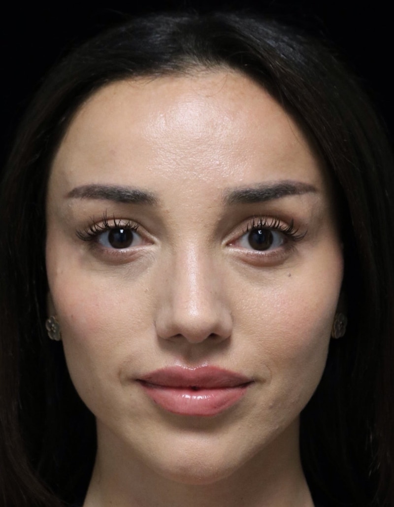 Beverly Hills Rhinoplasty Before & After Gallery - Patient 254674 - Image 10 Dr. Deepak Raj Dugar