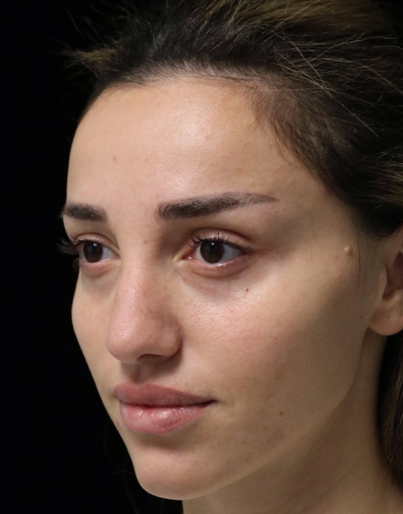 Beverly Hills Rhinoplasty Before & After Gallery - Patient 254674 - Image 7 Dr. Deepak Raj Dugar