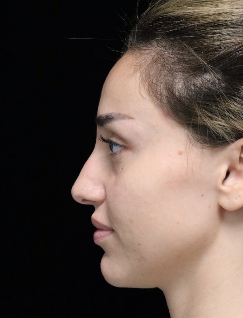 Beverly Hills Rhinoplasty Before & After Gallery - Patient 254674 - Image 5 Dr. Deepak Raj Dugar