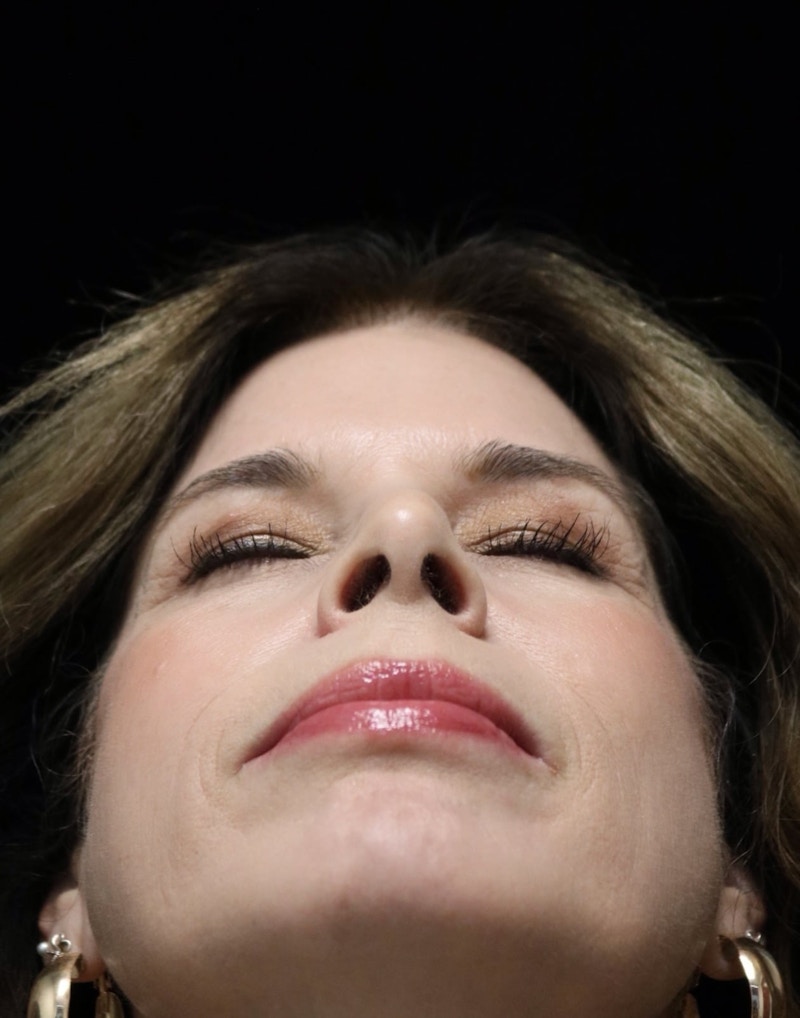 Beverly Hills Rhinoplasty Before & After Gallery - Patient 137278 - Image 14 Dr. Deepak Raj Dugar
