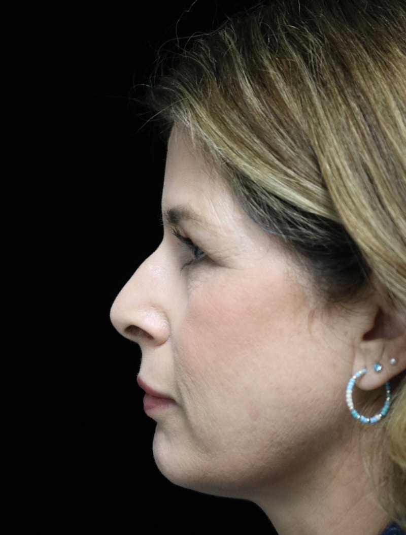 Beverly Hills Rhinoplasty Before & After Gallery - Patient 137278 - Image 5 Dr. Deepak Raj Dugar