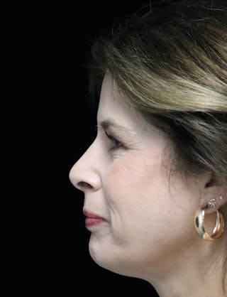 Beverly Hills Rhinoplasty Before & After Gallery - Patient 137278 - Image 6 Dr. Deepak Raj Dugar