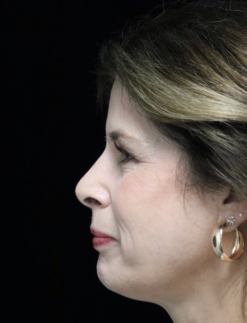 Beverly Hills Rhinoplasty Before & After Gallery - Patient 137278 - Image 6 Dr. Deepak Raj Dugar
