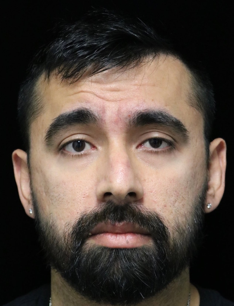 Beverly Hills Rhinoplasty Before & After Gallery - Patient 401524 - Image 9 Dr. Deepak Raj Dugar