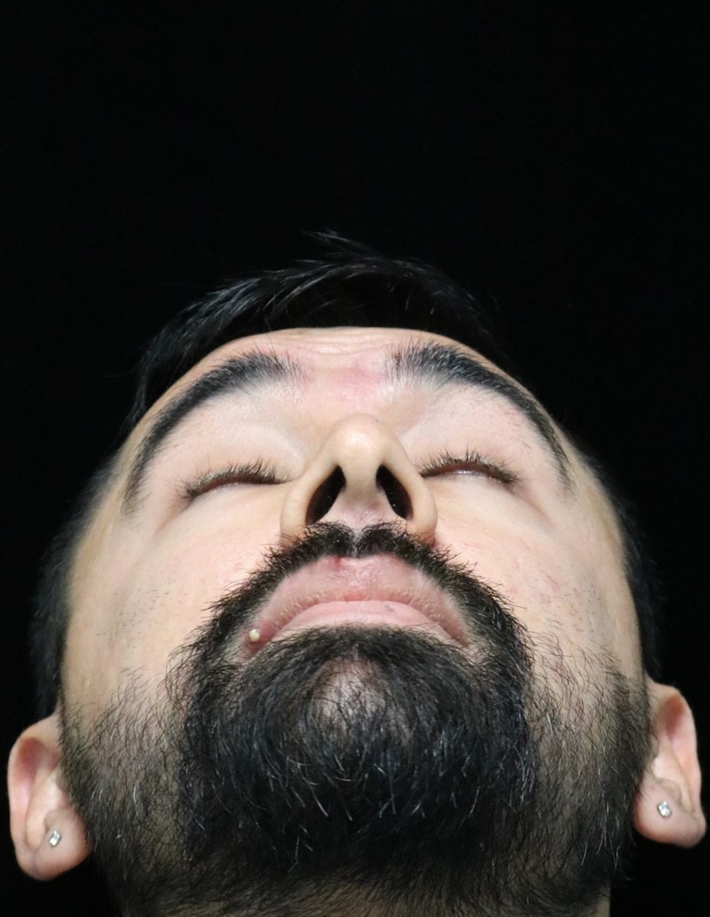 Beverly Hills Rhinoplasty Before & After Gallery - Patient 401524 - Image 13 Dr. Deepak Raj Dugar