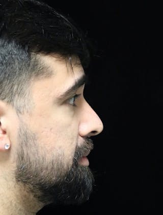Beverly Hills Rhinoplasty Before & After Gallery - Patient 401524 - Image 2 Dr. Deepak Raj Dugar
