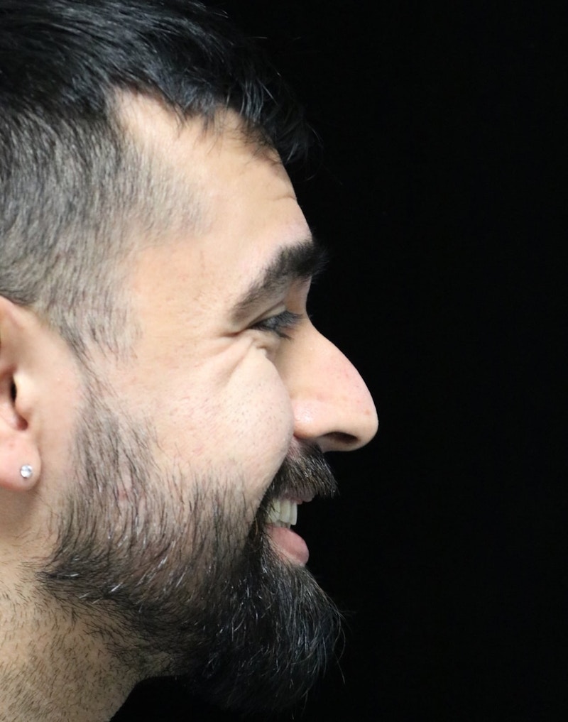 Beverly Hills Rhinoplasty Before & After Gallery - Patient 401524 - Image 3 Dr. Deepak Raj Dugar