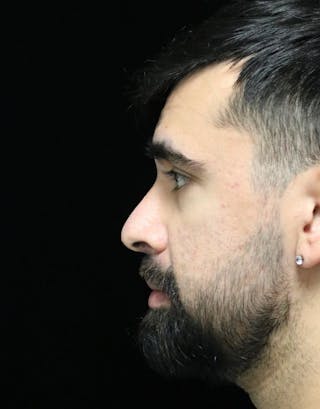 Beverly Hills Rhinoplasty Before & After Gallery - Patient 401524 - Image 6 Dr. Deepak Raj Dugar