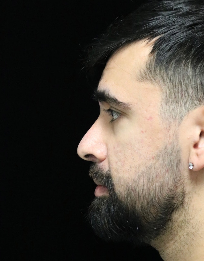 Beverly Hills Rhinoplasty Before & After Gallery - Patient 401524 - Image 6 Dr. Deepak Raj Dugar