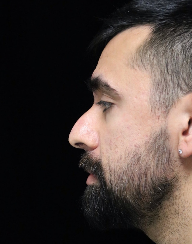 Beverly Hills Rhinoplasty Before & After Gallery - Patient 401524 - Image 5 Dr. Deepak Raj Dugar