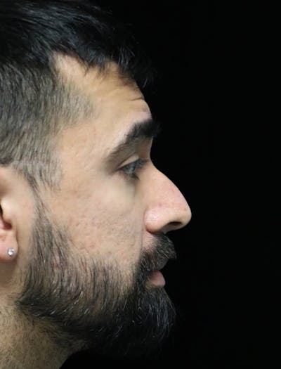 Rhinoplasty Before & After Gallery - Patient 401524 - Image 1