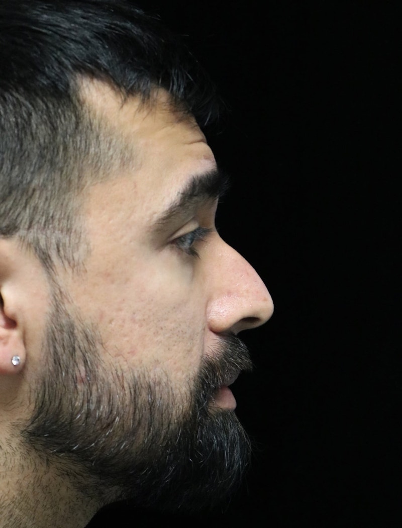 Beverly Hills Rhinoplasty Before & After Gallery - Patient 401524 - Image 1 Dr. Deepak Raj Dugar
