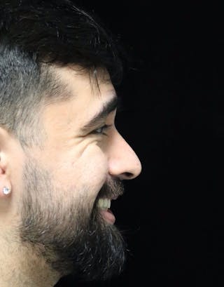 Beverly Hills Rhinoplasty Before & After Gallery - Patient 401524 - Image 4 Dr. Deepak Raj Dugar
