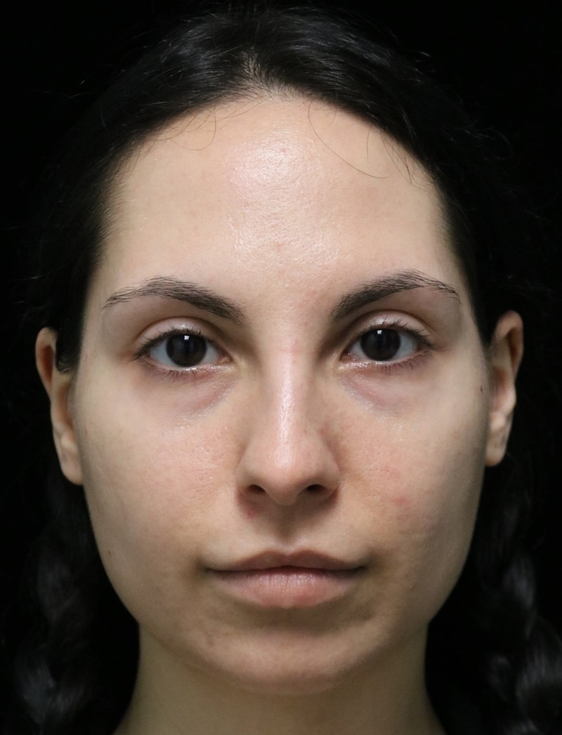 Beverly Hills Rhinoplasty Before & After Gallery - Patient 937220 - Image 9 Dr. Deepak Raj Dugar