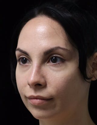 Beverly Hills Rhinoplasty Before & After Gallery - Patient 937220 - Image 8 Dr. Deepak Raj Dugar