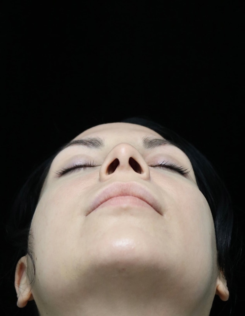Beverly Hills Rhinoplasty Before & After Gallery - Patient 937220 - Image 14 Dr. Deepak Raj Dugar