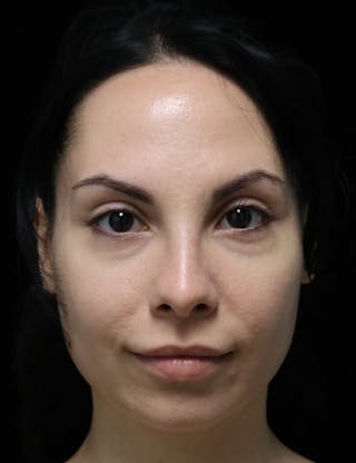 Beverly Hills Rhinoplasty Before & After Gallery - Patient 937220 - Image 10 Dr. Deepak Raj Dugar
