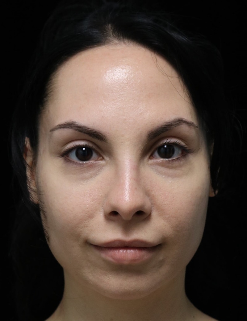 Beverly Hills Rhinoplasty Before & After Gallery - Patient 937220 - Image 10 Dr. Deepak Raj Dugar