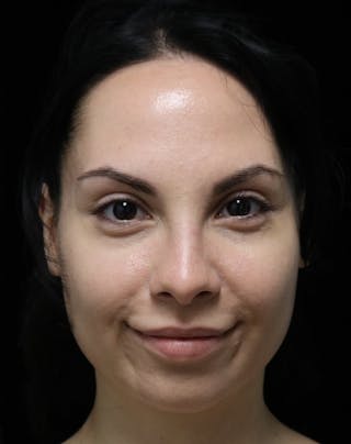 Beverly Hills Rhinoplasty Before & After Gallery - Patient 937220 - Image 12 Dr. Deepak Raj Dugar