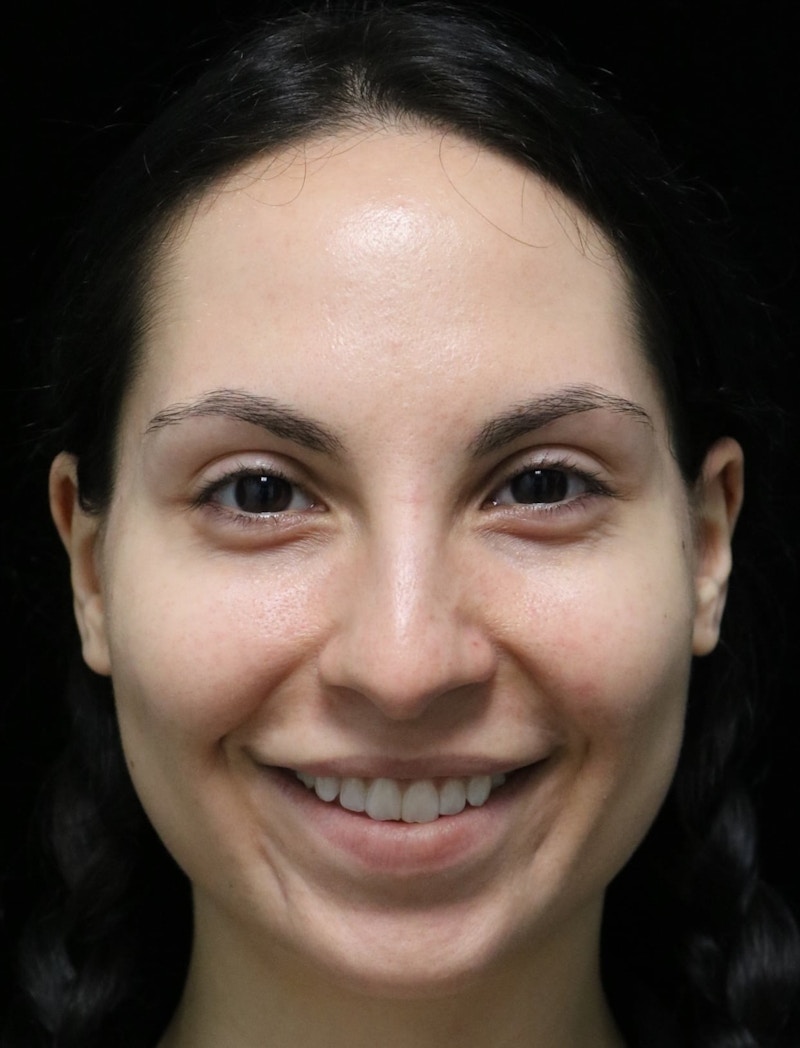 Beverly Hills Rhinoplasty Before & After Gallery - Patient 937220 - Image 11 Dr. Deepak Raj Dugar