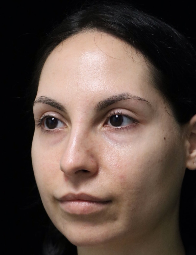 Beverly Hills Rhinoplasty Before & After Gallery - Patient 937220 - Image 7 Dr. Deepak Raj Dugar
