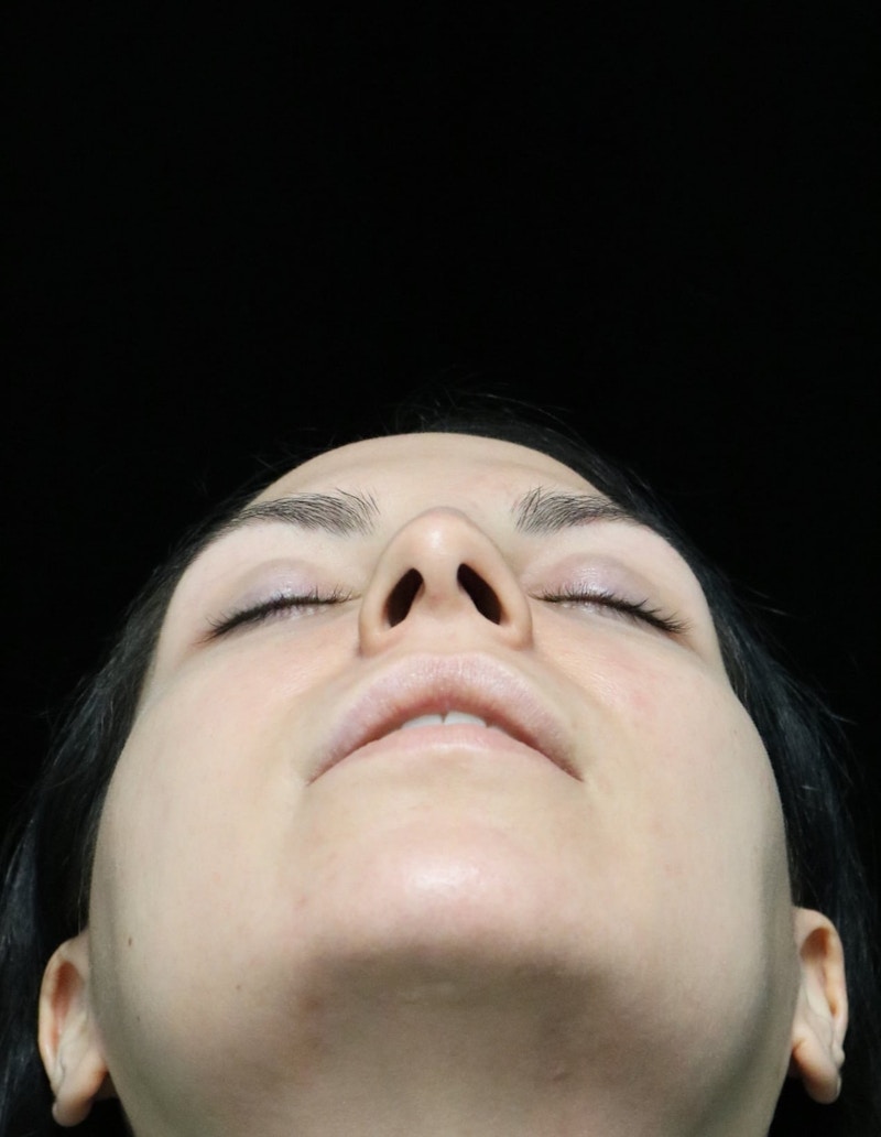 Beverly Hills Rhinoplasty Before & After Gallery - Patient 937220 - Image 13 Dr. Deepak Raj Dugar