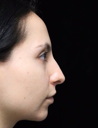 Rhinoplasty Before & After Gallery - Patient 937220 - Image 1