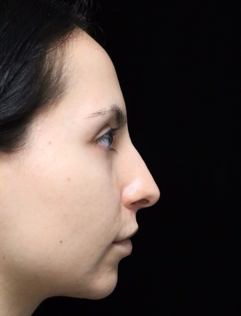 Beverly Hills Rhinoplasty Before & After Gallery - Patient 937220 - Image 1 Dr. Deepak Raj Dugar