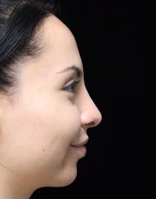 Beverly Hills Rhinoplasty Before & After Gallery - Patient 937220 - Image 4 Dr. Deepak Raj Dugar