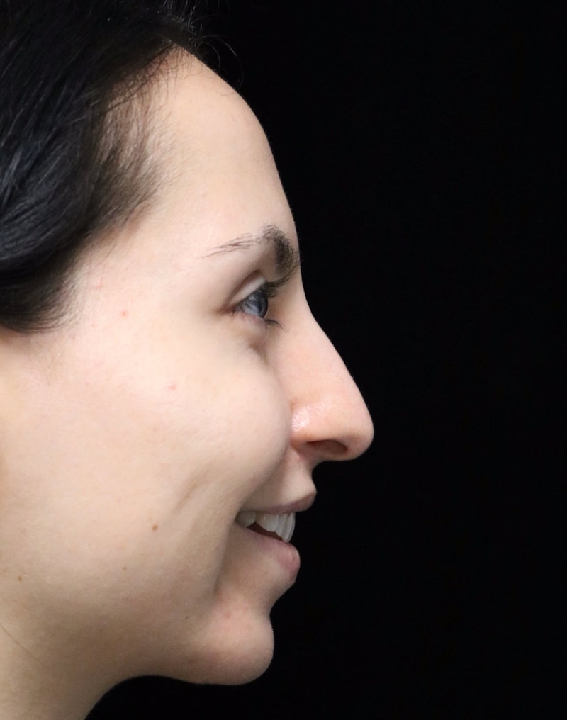 Beverly Hills Rhinoplasty Before & After Gallery - Patient 937220 - Image 3 Dr. Deepak Raj Dugar