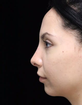 Beverly Hills Rhinoplasty Before & After Gallery - Patient 937220 - Image 6 Dr. Deepak Raj Dugar