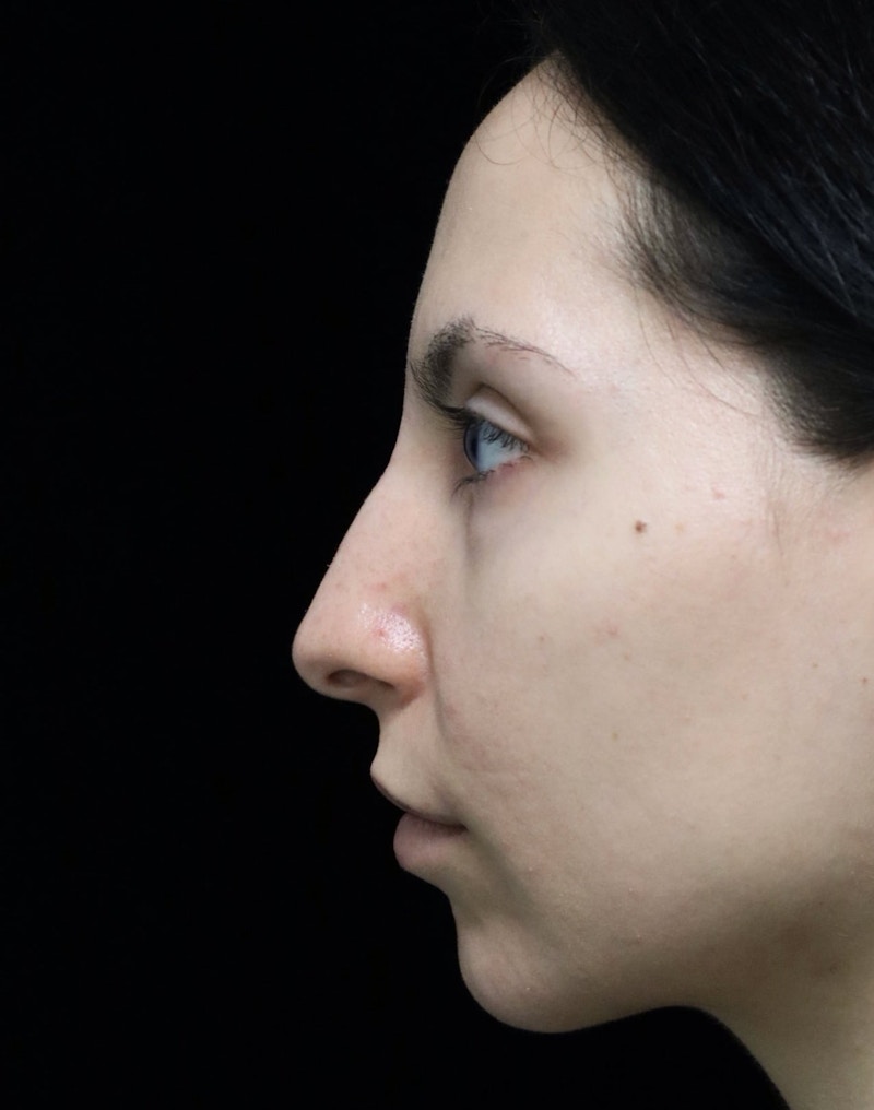 Beverly Hills Rhinoplasty Before & After Gallery - Patient 937220 - Image 5 Dr. Deepak Raj Dugar