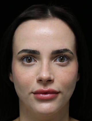 Beverly Hills Rhinoplasty Before & After Gallery - Patient 251812 - Image 10 Dr. Deepak Raj Dugar