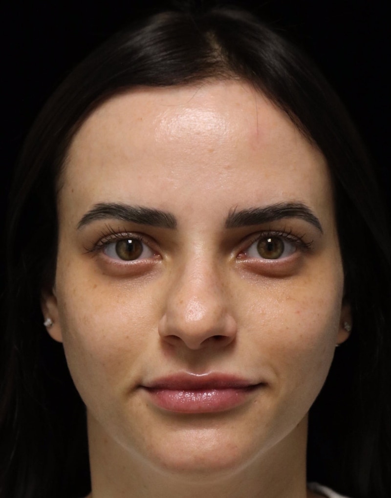Beverly Hills Rhinoplasty Before & After Gallery - Patient 251812 - Image 9 Dr. Deepak Raj Dugar