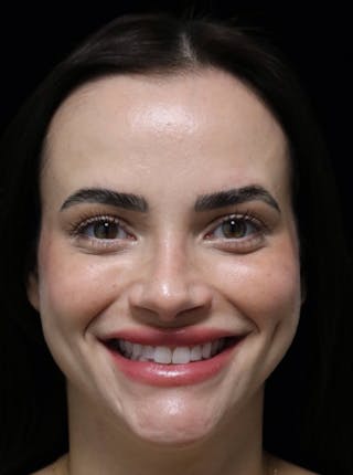 Beverly Hills Rhinoplasty Before & After Gallery - Patient 251812 - Image 12 Dr. Deepak Raj Dugar