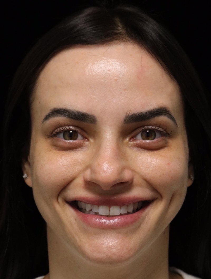 Beverly Hills Rhinoplasty Before & After Gallery - Patient 251812 - Image 11 Dr. Deepak Raj Dugar
