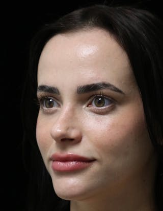 Beverly Hills Rhinoplasty Before & After Gallery - Patient 251812 - Image 8 Dr. Deepak Raj Dugar
