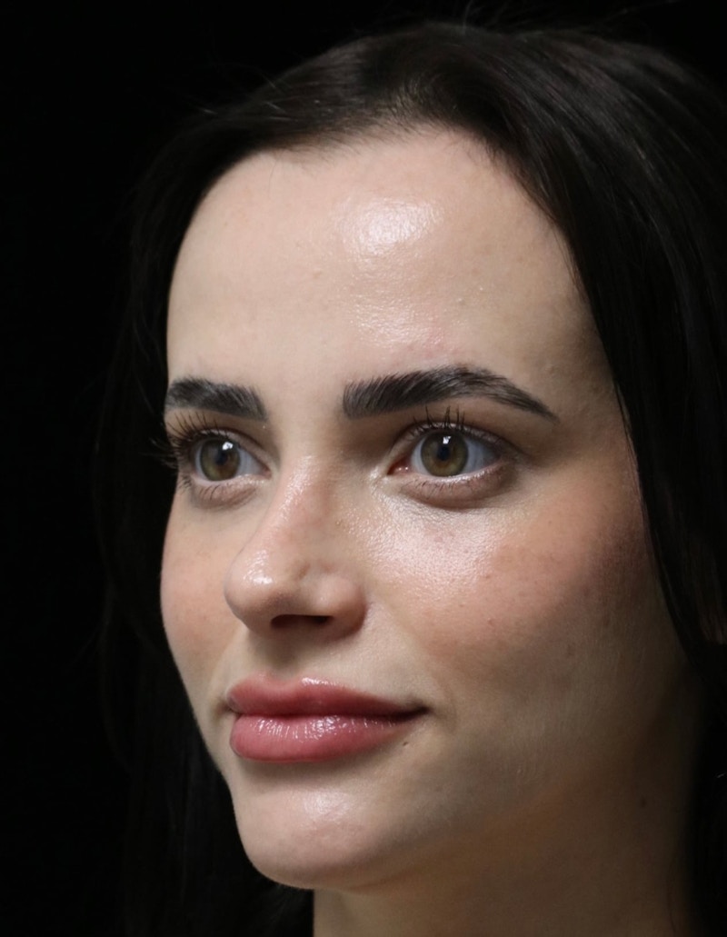 Beverly Hills Rhinoplasty Before & After Gallery - Patient 251812 - Image 8 Dr. Deepak Raj Dugar