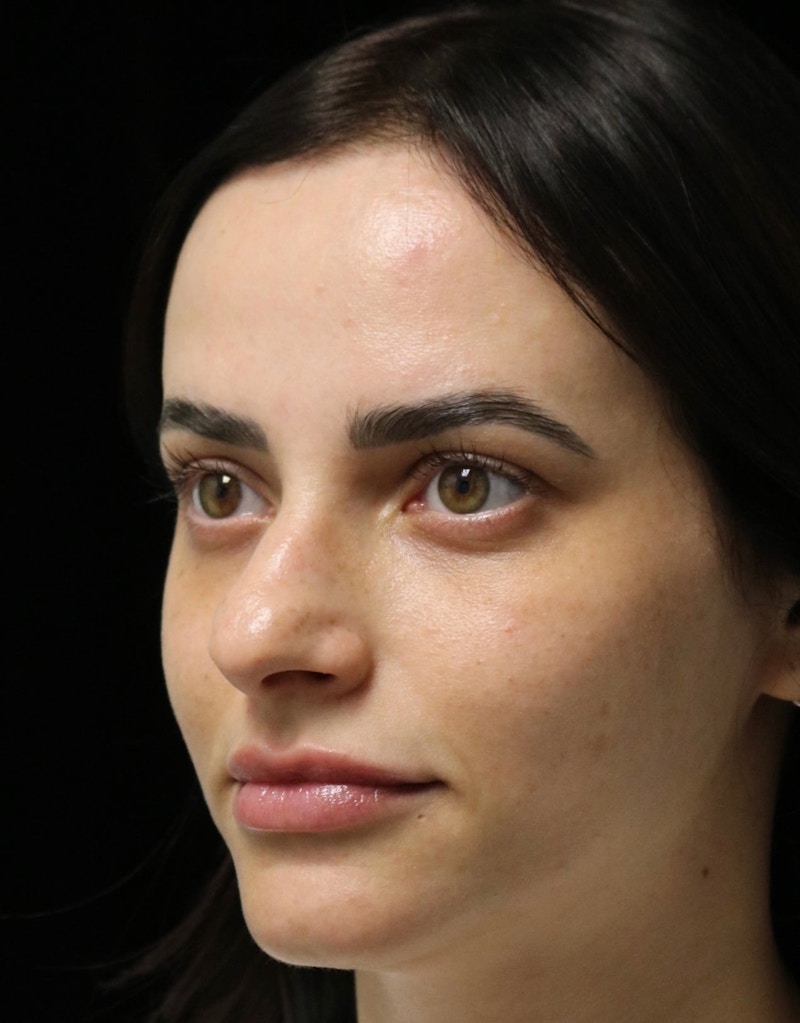 Beverly Hills Rhinoplasty Before & After Gallery - Patient 251812 - Image 7 Dr. Deepak Raj Dugar