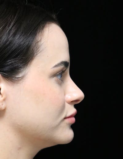 Beverly Hills Rhinoplasty Before & After Gallery - Patient 251812 - Image 2 Dr. Deepak Raj Dugar