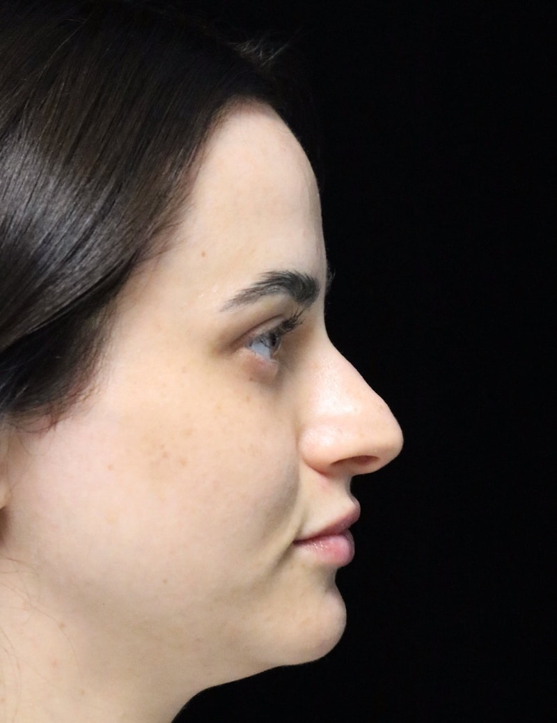 Beverly Hills Rhinoplasty Before & After Gallery - Patient 251812 - Image 1 Dr. Deepak Raj Dugar