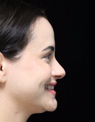 Beverly Hills Rhinoplasty Before & After Gallery - Patient 251812 - Image 4 Dr. Deepak Raj Dugar